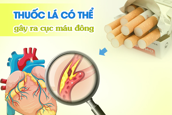 Thuốc lá có thể gây ra cục máu đông.
